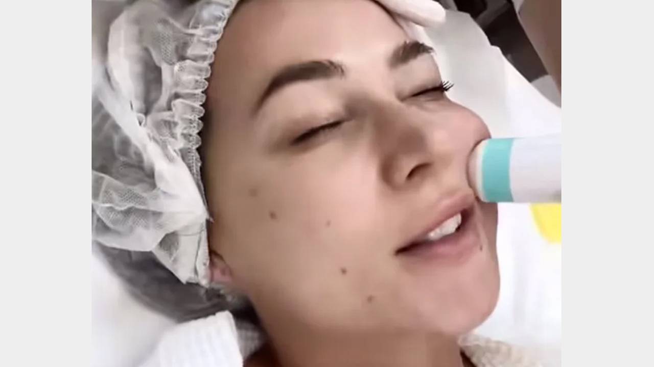 Блогерша Лерчек показала видео после подтяжки лица