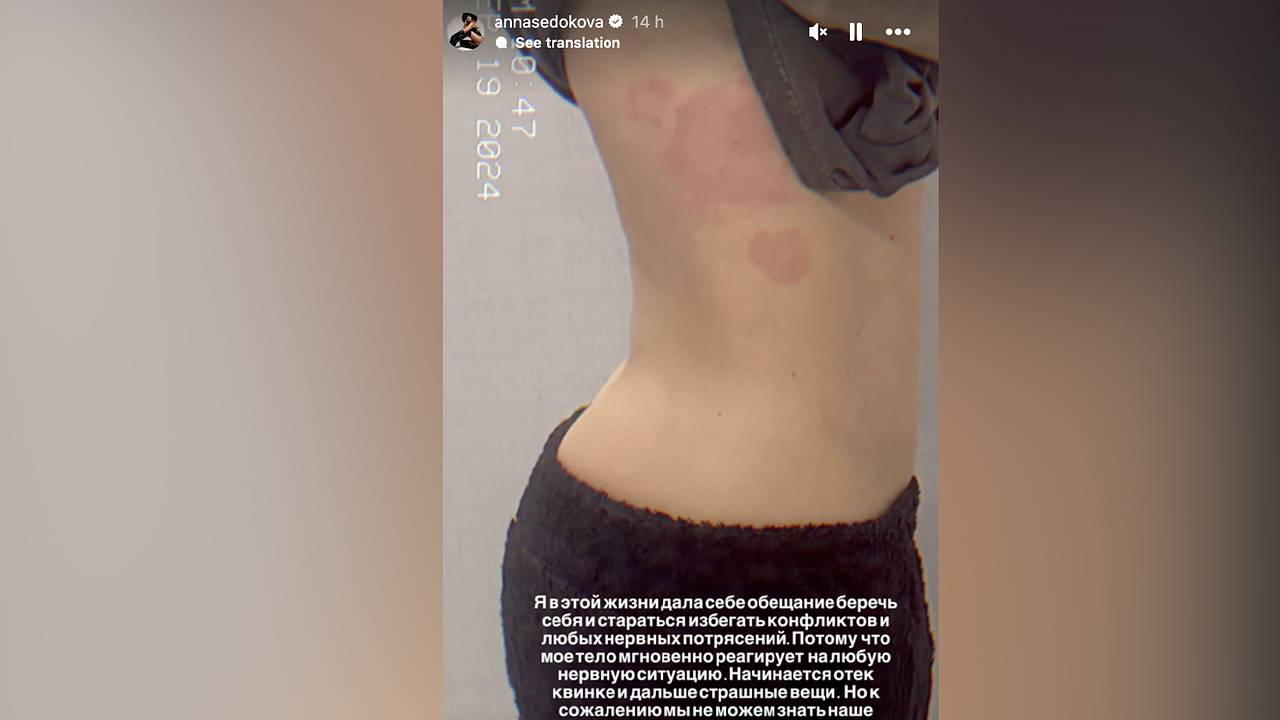 Анна Седокова показала тело с сыпью и объяснила причину недуга
