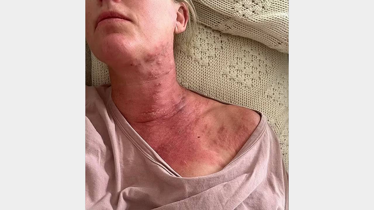 Туристка покрылась сыпью на Бали и описала болезнь словами «хуже, чем роды»