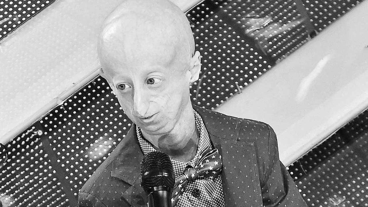 Умер самый известный человек с синдромом преждевременного старения